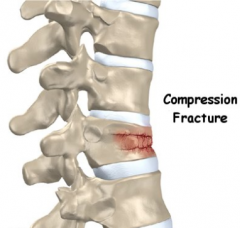 - History – usually sudden thoracic or lumbar pain, often little to no trauma
- Etiology – majority related to osteoporosis, older patients; anterior vertebral body wedge fracture. T10, T11, T12, L1 most commonly. In younger patients w/o clea...