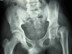 - History – classically an overweight early adolescent with history of groin or knee pain, which may be referred to anteromedial thigh. Often occurs bilaterally (but not simultaneously)
- Etiology – repetitive overload
- Presentation – Vag...