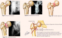 - I: impaction of superior portion of femoral neck (incomplete)
- II: non-displaced fracture (complete)
- III: partial displacement between femoral head and neck
- IV: complete displacement between femoral head and neck