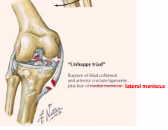 Force to lateral side of knee causes:
- Damage to ACL and MCL
- Also damage to lateral meniscus (compression injury)