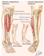 - Anterior: excessive contraction of anterior compartment muscles
- Lateral: excessively mobile ankle joint in which hypereversion irritates the lateral compartment muscles