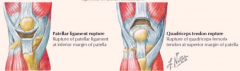 Rupture of patellar tendon (d/t direct trauma in younger person) or quadriceps tendon (d/t minor trauma or age-related degeneration in older adults)
