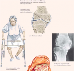 - Painful associated w/ activity
- Weather may precipitate painful episodes
- Stiffness after inactivity
- Decreased ROM
- Subluxation of knee may occur w/ a varus (bowleg) deformity