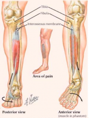 - Pain along inner distal 2/3 of tibial shaft
- Chronic conditions can cause periostitis and bone remodeling or stress fractures
