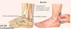 - Inflammation of subtendinous bursa between the overlying tendon and the calcaneus
- Presents as a tender area just anterior to tendon attachment