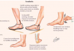 - Runners who run on hills or uneven surfaces
- Repetitive stress on tendon occurs as heel strikes ground and when plantarflexion lifts foot and toes