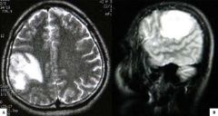 1. autosomal recessive
2. FAP tumors plus cerebellar medulloblastoma or gliobastoma multiforme
(think Turcots- turban-- affects your brain)