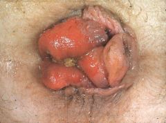 - 20-30% of all CRCs
- hematochezia- most common symptom
- tenesmus- feeling the need to pass stool constantly even though the colon is empty- can be very painful
- rectal mass- feeling of incomplete evacuation of stool (due to mass)
