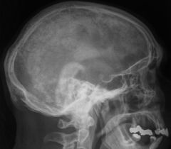 

A 78-year-old man is investigated for headaches. A routine blood screen is normal other than an elevated ALP. A skull x-ray is ordered:



dx