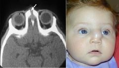 Present as a midline nasal pit, fistula, or infected mass located anywhere from the glabella to the nasal columella. May present as intranasal, intracranial or extranasal masses along the nasal dorsum

Mass is nontender, noncompressible, and fir...