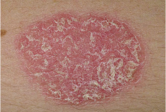

Thick, red patches of skin covered with white or silvery scales are signs of psoriasis. Doctors know how psoriasis works -- your immune system triggers new skin cells to grow too quickly -- but they don't now what causes it.  The patches sho...