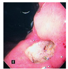 What are some characteristics of BENIGN gastric ulcers? 


 


What can be used to diagnose the lesion with a high sensitivity?


 