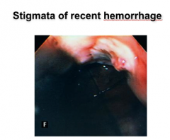 What is the chance of the stigmata rebleeding? 
