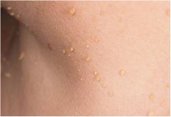 This small flap of flesh-colored or slightly darker tissue hangs off your skin by a stalk. They're usually found on the neck, chest, back, armpits, under the breasts, or in the groin area. Skin tags appear most often on women and elderly people. T...