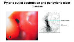 Pyloric outlet obstruction and peripyloric ulcer disease is ___ (common or uncommon). Acutely, obstruction may result from _____. In some patients, however, ______ results in fixed fibrosis and outlet obstruction.  In this patient presenting with...