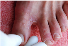 Athlete's foot (tinea pedis) is a fungal infection that usually begins between the toes. It occurs most commonly in people whose feet have become very sweaty while confined within tight-fitting shoes.Signs and symptoms of athlete's foot include a ...