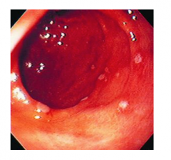 The observation of multiple erosive and hemorrhagic lesions may be defined endoscopically as ______. This figure is an example of endoscopic erosive ______. Common settings that may lead to endoscopic gastritis include use of ______ drugs, alcohol...
