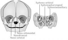 Sincipital encephaloceles AKA frontoethmoidal encephaloceles

Present as an external mass over nose, glabella or forehead

Subtypes:
1) Nasofrontal
2) Nasoethmoidal
3) Naso-orbital