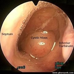 Benign nasopharyngeal cyst
Develops from remnant of notochord

Sx: postnasal drip, haliotosis, aural fullness, serous otitis media, and cervical pain

Examination: smooth submucosal midline mass in nasopharynx

Tx: none if assx; if sx, mars...