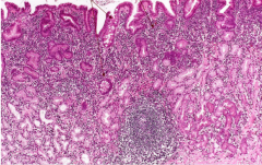 Identify the intestinal metaplasia! 


 


Identify the numerous inflammatory cells in the lamina propria! 