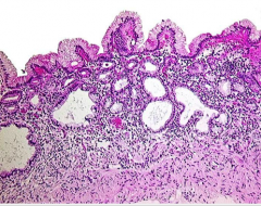 What is shown here that is less than 10% of chronic gastritis? What do antibodies attack that leads to what two conditions? 


 


Can you get metaplasia and hyperplasia? 