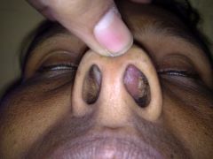 1) Catarrhal or atrophic: rhinitis, purulent rhinorrhea, and nasal crusting

2) Granulomatous or hypertrophic: small painless granulomatous lesions in upper respiratory tract that block nasal passages

3) Sclerotic: sclerosis and fibrosis narr...