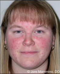 Rosacea (roe-ZAY-she-uh) is a common skin condition that causes redness in your face and often produces small, red, pus-filled bumps. Rosacea can be mistaken for acne

