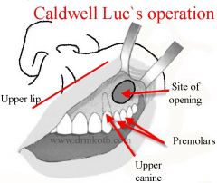 Caldwell-Luc to enter maxillary sinus
Enter posterior wall, vessels clipped