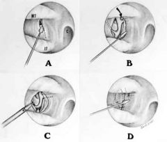 - Follow middle turb to posterior aspect
- Make vertical incision approximately 7-8mm anterior to the posterior end of middle turbinate
- Crista ethmoidalis seen and marks anterior sphenopalatine foramen; vessels are posterosuperior to this
- C...