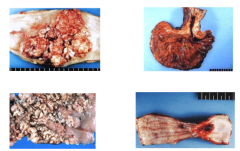 Identify the four different presentations of esophageal squamous cell carcinoma: 


 


Numerous small coalescing nodules, diffuse circumferential thickening, stricture with hemorrhagic ulcer, fungating obstructive polypoid mass 