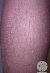 What condition is associated with the following symptoms?
- Fish scales (especially on shins)
- Extremely dry skin
- Hyperlinear palms

What is the cause?