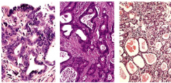 Esophageal adeocarcinoma


 


Which one shows nuclear atypia the best? 