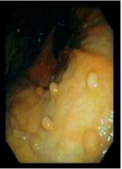 What is the condition? Seen with what conditions? Is it usually asymptomatic? Does it often become malignant? 


What is the treatment? What percent of gastric polyps? 