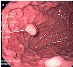Fundic gastric polyp:


 


Where do they occur? 


Size usually?


Are they sporadic? What are they often associate with? 


 


Do they have malignant potential? 


 


What is the treatment? 