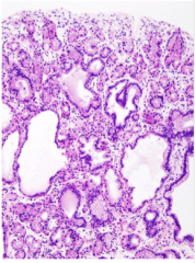 What is this?


 


Cystically dilated

glands lined by all the

cell types characteristic

of the fundus, but

especially ______ cells

(acid-producing parietal

 cells), without excess

 inflammation in the

 lamina propria

 


 


 