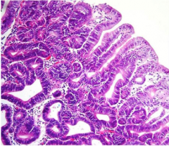 What type of polyp? Neoplasm composed of what shape of glands?


 


What will you see in dysplasia? 


Severe dysplasia? 


 


What is the risk of malignant transformation? 