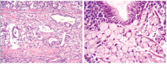 Gastric adenocarcinoma:


 


Where are the malignant cells invading? What is the signature histologic pattern? 