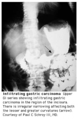 Radiology of gastric cancer. 