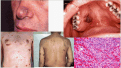 Kaposi Sarcoma is caused by HHV-8 (KSHV) and causes sarcomas of the skin, mouth, GI, and lungs. Diagnosis is made by biopsy and treatment is chemo. 