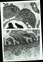 *Note hairy looking foot processes.
*Proteinuria and "minimal change disease" will lead to fusion of the processes!

*Bottom pic: lower portion is a capillary lumen. Cytoplasm of an endothelial cell is to the left of the arrowhead. Gap indicate...
