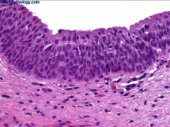 Ureter. Transitional epithelium lines all of the urinary tract from the calyces to the distal urethra.