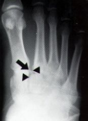 1-Transverse instability of the Lisfranc joint is the result of injury to ___?, MoI (3) def lat column of midfoot?
2-what causes the Lis franc lig to tighten? is there direct lig attachment between 1st and 2nd MT
3- which tarsometatarsal lig are...