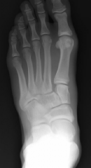 A 24-year-old man sustains an injury to his left foot. Stress radiographs are seen in Figure A. Injury to which ligament or ligaments are needed to produce the transverse instability seen here?  
1.  Spring ligament and bifurcate ligament 
2.  I...