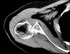 1-post shoulder dislocation, r/o fx of lesser tuberosity MUST get axillary lat; axillary nerv I
2(3) bony-Post glenoid rim fx, Lesser tuberosity fx, Reverse Hill-Sachs (hum)
(4)-ST-Large capsular pouch, Posterior labral cyst, Posterior Bankart L...