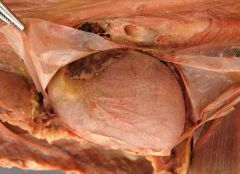 The fibroserous sac enclosing the heart; composed fo the fibrous and serous pericardium covered by mediastinal (pericardiac) pleura