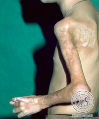 - Acquired autoimmune disease
- Thickening of collagen (sclerosis)
- Children and adults, females > males