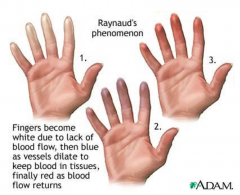 CREST Syndrome:
- Calcinosis cutis - calcium deposits in skin
- Raynaud phenomenon - fingers turn white d/t lack of blood flow, then blue as vessels dilate, then red as flood flow returns (white-blue-red)
- Esophageal dysmotility
- Sclerodacty...