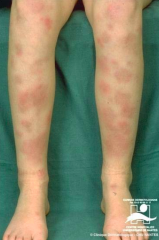 - Tender, red nodules that arise on shins
- May arise in crops, then slowly involute over course of a few days or weeks