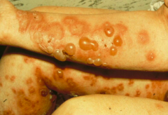 What kind of diagnostic tests are done to confirm Bullous Pemphigoid?