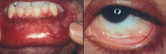 - Recurrent blistering of mucous membranes, but also skin
- Develop scars, strictures, synechiae, and blindness (20%)